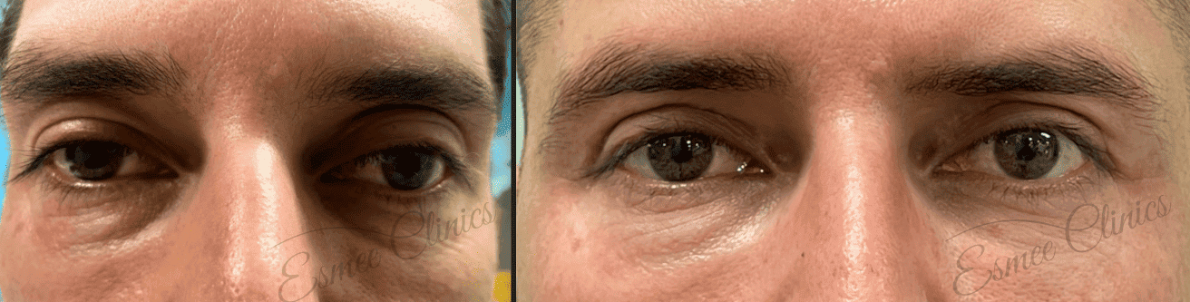 Before and After img